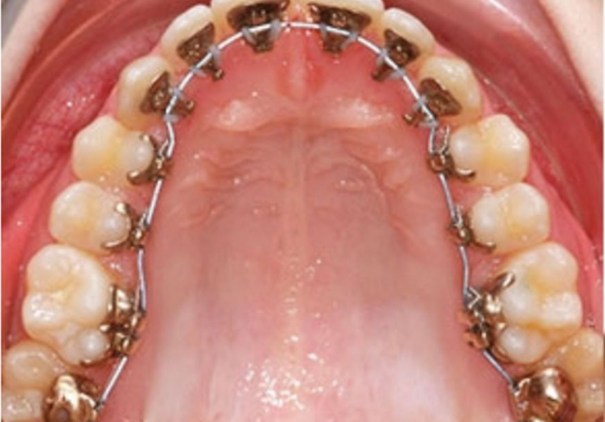 Erişkin Ortodonti 1