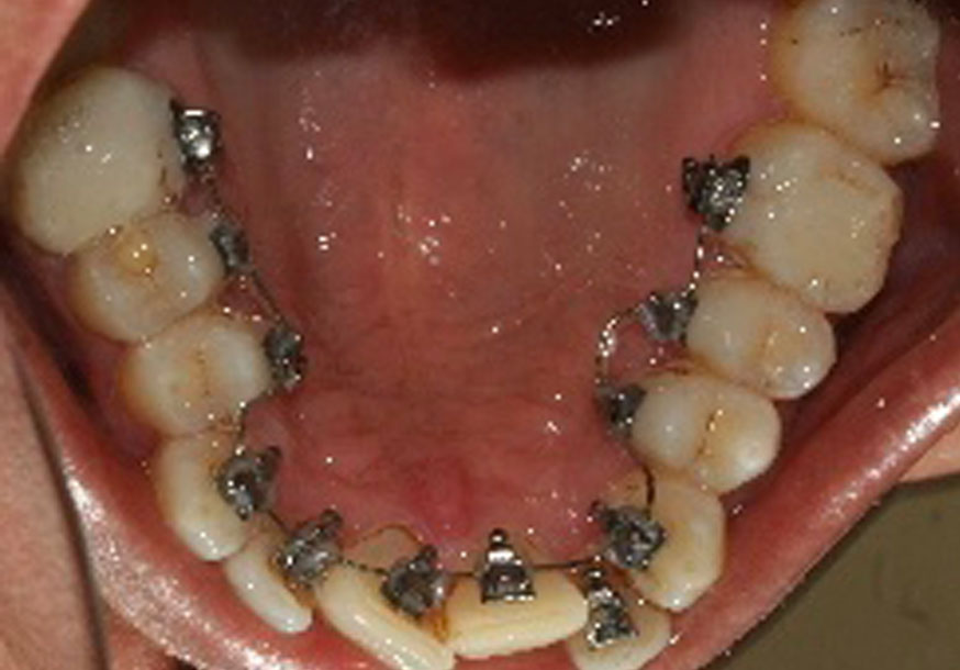 Erişkin Ortodonti 2