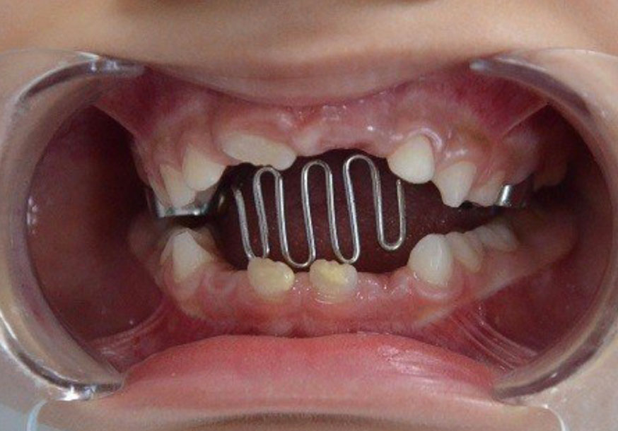 Erken Ortodonti 2