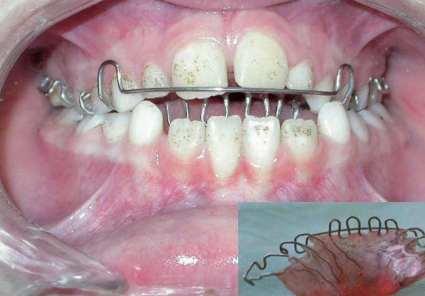 Erken Ortodonti 3
